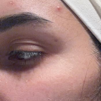 Kullandığım Makyaj Temizleme Yağı Cildimde Kalıcı Sivilcelere Sebep Oldu, Ücret İadesi Talep Ediyorum