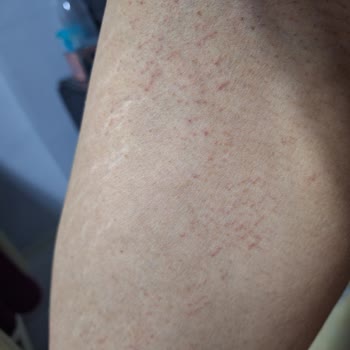 İbni Sina Lazer Epilasyon (Siirt) Sağlık Açısından Ve Estetik Olarak Ciddi Zarar Gördüm!