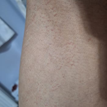 İbni Sina Lazer Epilasyon (Siirt) Sağlık Açısından Ve Estetik Olarak Ciddi Zarar Gördüm!