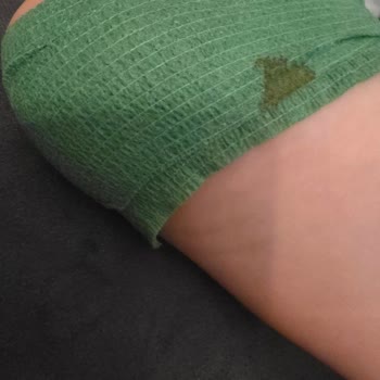 Kızımın Ayağına Botun İçindeki Vida Battı, Personel Umursamaz Davrandı!