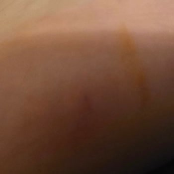 Kızımın Ayağına Botun İçindeki Vida Battı, Personel Umursamaz Davrandı!