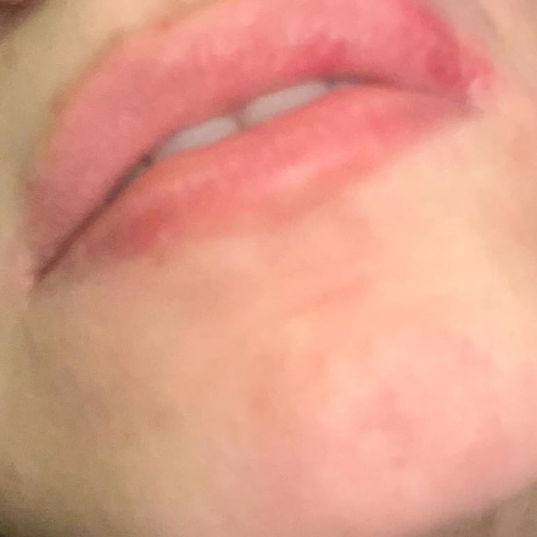 Parodontax Kullanımı Sonrası Ciddi Alerjik Reaksiyon Ve Sağlık Sorunları