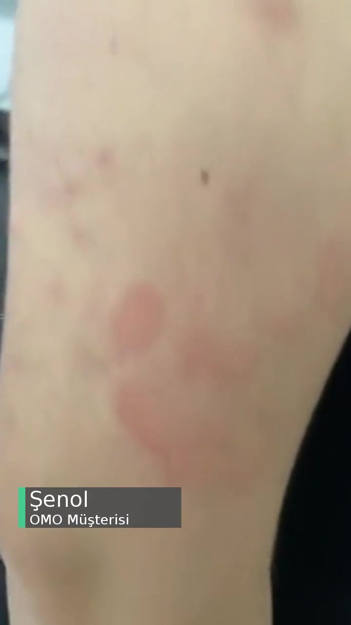 OMO Express Fresh Alerjik Reaksiyona Sebep Oldu! videonun kapak resmi