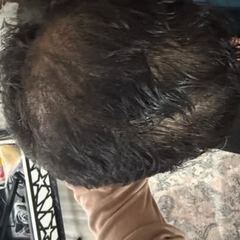 Clinic Expert’te Saç Ekimi Sonrası Mağduriyet Ve Çözüm Taleplerim Karşılanmadı