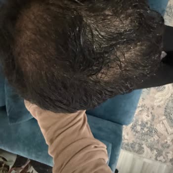 Clinic Expert’te Saç Ekimi Sonrası Mağduriyet Ve Çözüm Taleplerim Karşılanmadı