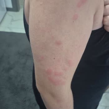 OMO Express Fresh Sıvı Deterjan Çocuğumda Ciddi Alerjik Reaksiyona Sebep Oldu