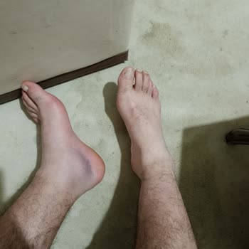 Tehlikeli Merdiven Paspası Nedeniyle Yaşanan Ciddi Yaralanma Ve Güvenlik Talebi