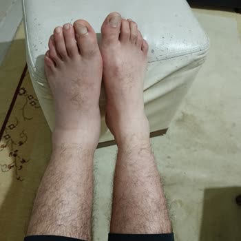 Tehlikeli Merdiven Paspası Nedeniyle Yaşanan Ciddi Yaralanma Ve Güvenlik Talebi