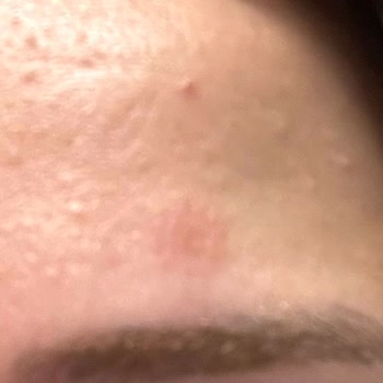 Cream.co Nemlendirici Kremde Ciltte Kızarıklık Ve Egzama Benzeri Reaksiyon