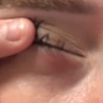 Cream.co Nemlendirici Kremde Ciltte Kızarıklık Ve Egzama Benzeri Reaksiyon