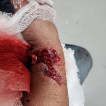 Ameliyat Tarihinde Belirsizlik Ve Yetersiz Bilgilendirme Nedeniyle Mağduriyet