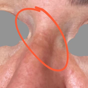 Lazer Tedavisi Sonrası Yüzümde Kalıcı Hasar Ve Mağduriyet