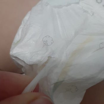 Sleepy Bebek Bezinden Çıkan Yabancı Madde Kızımın Canını Yaktı