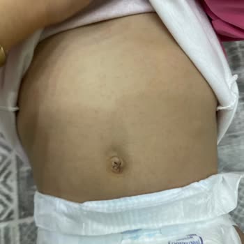 Molfix 5 Numara Bebek Bezinde Üretim Hatası Ve Cilt Sorunları