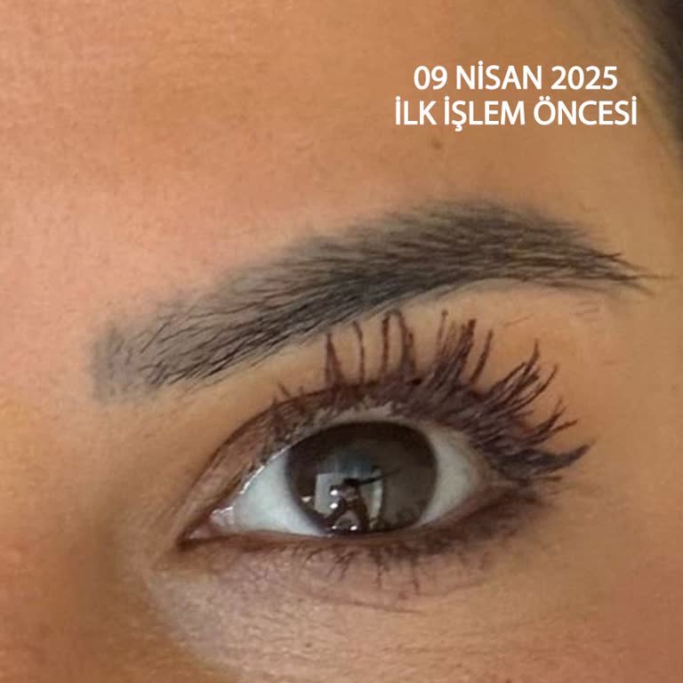 Serap Çınar Kaş Silme İşleminde Sonuçsuzluk ve Faturasız Hizmet Deneyimi