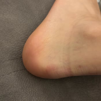 Aldığım Bot İlk Giyişte Ayağımı Yaraladı İade Talebim Reddedildi