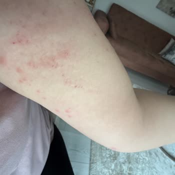 Suhan Hotel Böcek Isırıkları Nedeniyle Sağlık Ve Hijyen Sorunu!