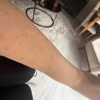 Suhan Hotel Böcek Isırıkları Nedeniyle Sağlık Ve Hijyen Sorunu!