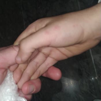 Suhan Hotel Böcek Isırıkları Nedeniyle Sağlık Ve Hijyen Sorunu!