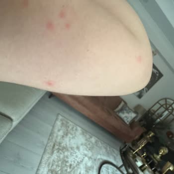 Suhan Hotel Böcek Isırıkları Nedeniyle Sağlık Ve Hijyen Sorunu!