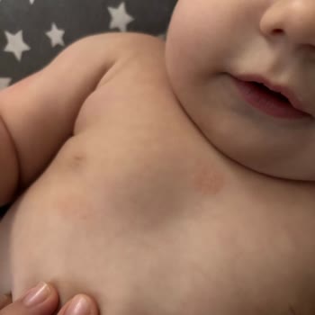 Mustela Bebek Göğüs Balmı Sonrası Ciltte Kızarıklık Ve Kabarcıklar Oluştu