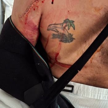 Scooterın Gidon Sorunu Nedeniyle Yaşadığım Ciddi Kaza Ve Mağduriyet