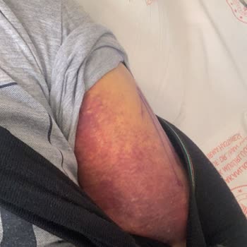 Scooterın Gidon Sorunu Nedeniyle Yaşadığım Ciddi Kaza Ve Mağduriyet