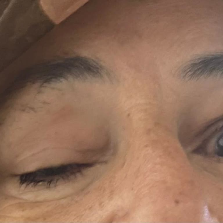 Göz Botoksu Sonrası Annemin Gözü Kapandı, Mağduriyetimiz Giderilmiyor