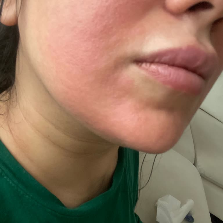 Retinol Serum Cildimde Ciddi Yanma Ve Kaşıntıya Neden Oldu