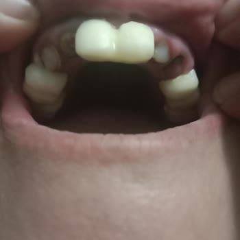 Geçici Dişler Hazırlanmadı, Mağdur Edildim