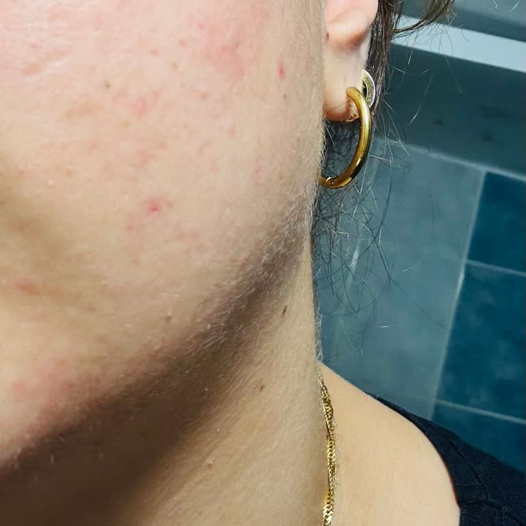 Bioderma Sebium Jel Cildimde Alerji Yaptı, Son Kullanma Tarihi Yok!