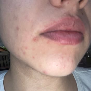 Cilt Tipime Uygun Önerilen Yüz Yıkama Jeli Sivilce Ve Kaşıntı Yaptı