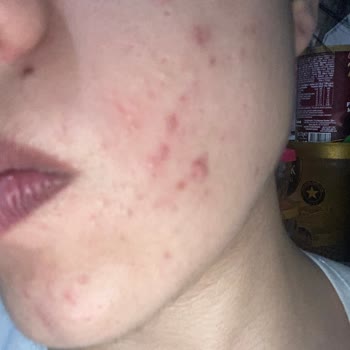 Cilt Tipime Uygun Önerilen Yüz Yıkama Jeli Sivilce Ve Kaşıntı Yaptı