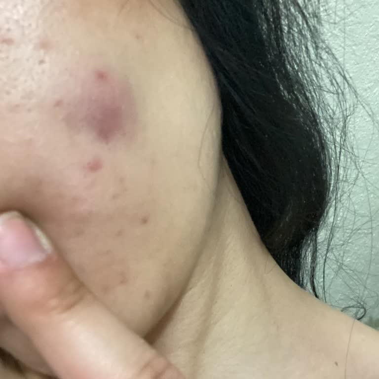 Cilt Tipime Uygun Önerilen Yüz Yıkama Jeli Sivilce Ve Kaşıntı Yaptı