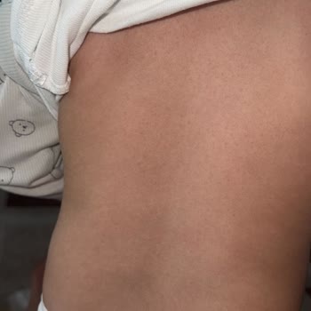 Son Kullanma Tarihi Geçmiş Islak Mendil Nedeniyle Cilt Sorunları Ve Mağduriyet