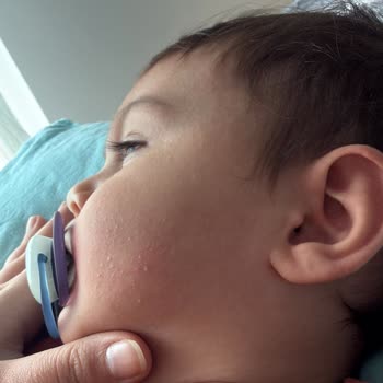 Son Kullanma Tarihi Geçmiş Islak Mendil Nedeniyle Cilt Sorunları Ve Mağduriyet