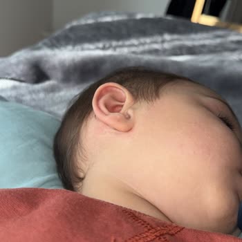 Son Kullanma Tarihi Geçmiş Islak Mendil Nedeniyle Cilt Sorunları Ve Mağduriyet