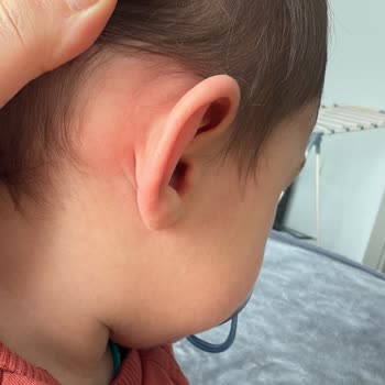 Son Kullanma Tarihi Geçmiş Islak Mendil Nedeniyle Cilt Sorunları Ve Mağduriyet