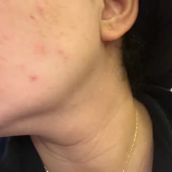 Rise & Shine Pirinç Özlü Sabun Yüzümde Ciddi Alerjik Reaksiyonlara Yol Açtı