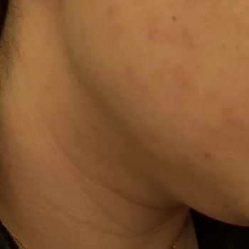 Rise & Shine Pirinç Özlü Sabun Yüzümde Ciddi Alerjik Reaksiyonlara Yol Açtı