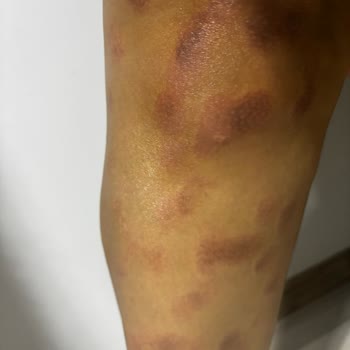 Acıbadem Hastanesi Lazer Epilasyon Sonrası Ciddi Yanıklar ve İlgisizlik Mağduriyetimi Artırdı