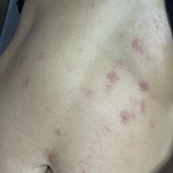 Acıbadem Hastanesi Lazer Epilasyon Sonrası Ciddi Yanıklar ve İlgisizlik Mağduriyetimi Artırdı