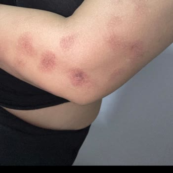 Acıbadem Hastanesi Lazer Epilasyon Sonrası Ciddi Yanıklar ve İlgisizlik Mağduriyetimi Artırdı