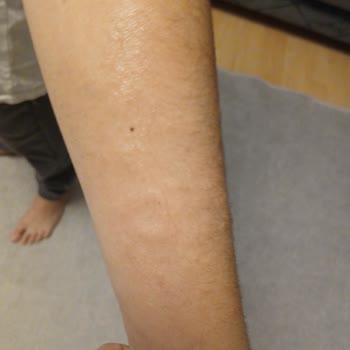 Argivit Focus Kullanan Oğlumda Alerjik Reaksiyon Ve Mide Bulantısı Yaşadık