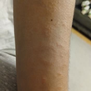 Argivit Focus Kullanan Oğlumda Alerjik Reaksiyon Ve Mide Bulantısı Yaşadık