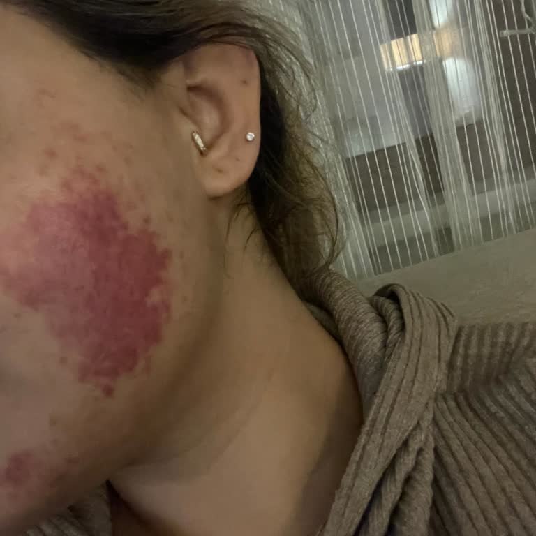 Yüz Temizleme Jeli Cildimde Ağır Alerjik Reaksiyona Sebep Oldu