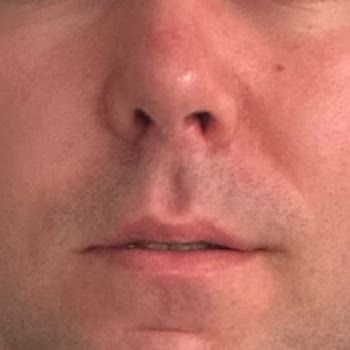 Burun Estetiği Sonrası Mağduriyet Ve İlgisizlik