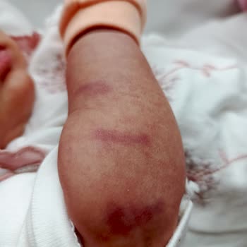 İki Aylık Bebeğimin Kolunda Hemşire Müdahalesi Sonrası Morluk Oluştu