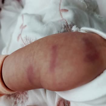 İki Aylık Bebeğimin Kolunda Hemşire Müdahalesi Sonrası Morluk Oluştu