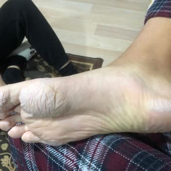 Aldığım Çocuk Botu Ayağını Tahriş Etti, İade Veya Değişim Talebim Reddedildi